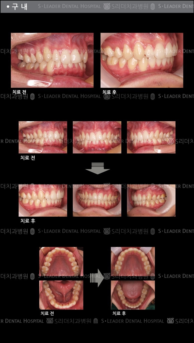 삐뚤삐뚤 치아교정 케이스 — 추가 사진 (치아교정)
