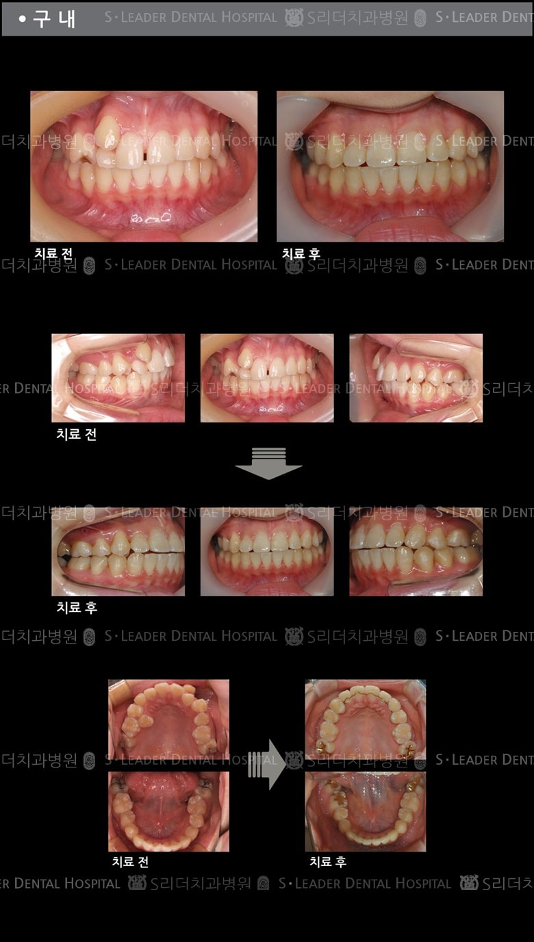 삐뚤삐뚤 치아교정 케이스 — 추가 사진 (치아교정)