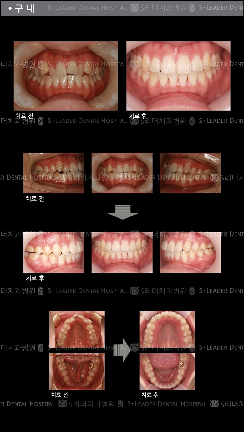삐뚤삐뚤 치아교정 케이스 (class3) — 추가 사진 (치아교정)