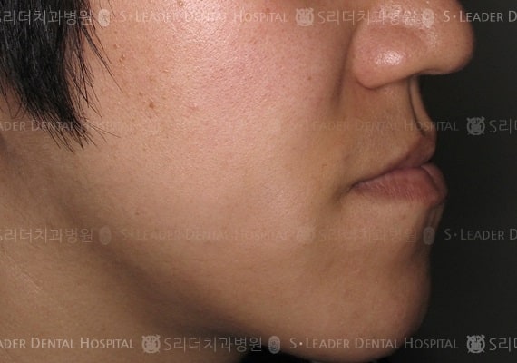 삐뚤삐뚤 치아교정 케이스 (Class3) (증례 230)
