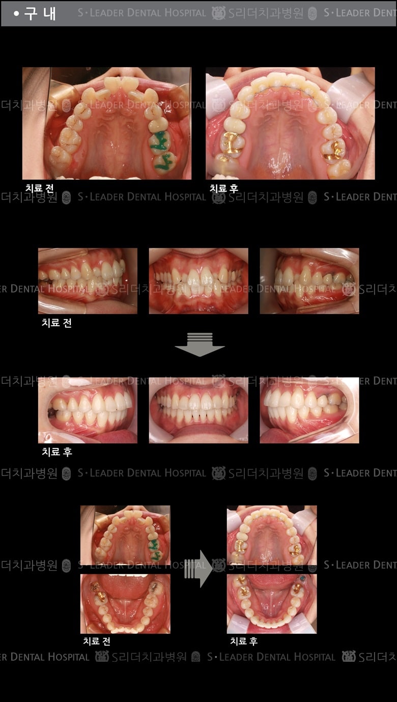 삐뚤삐뚤 치아교정 케이스 — 추가 사진 (치아교정)