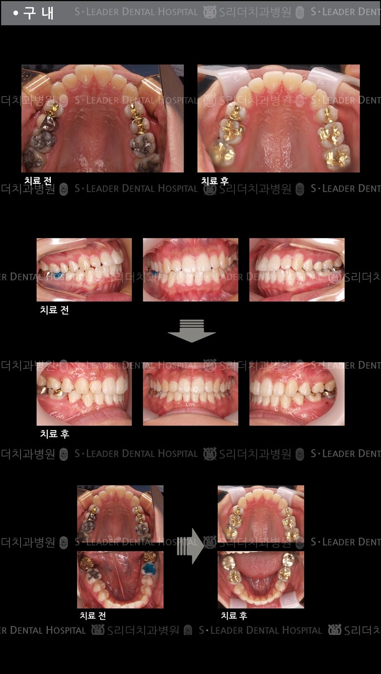 삐뚤삐뚤 치아교정 케이스 (class3) — 추가 사진 (치아교정)