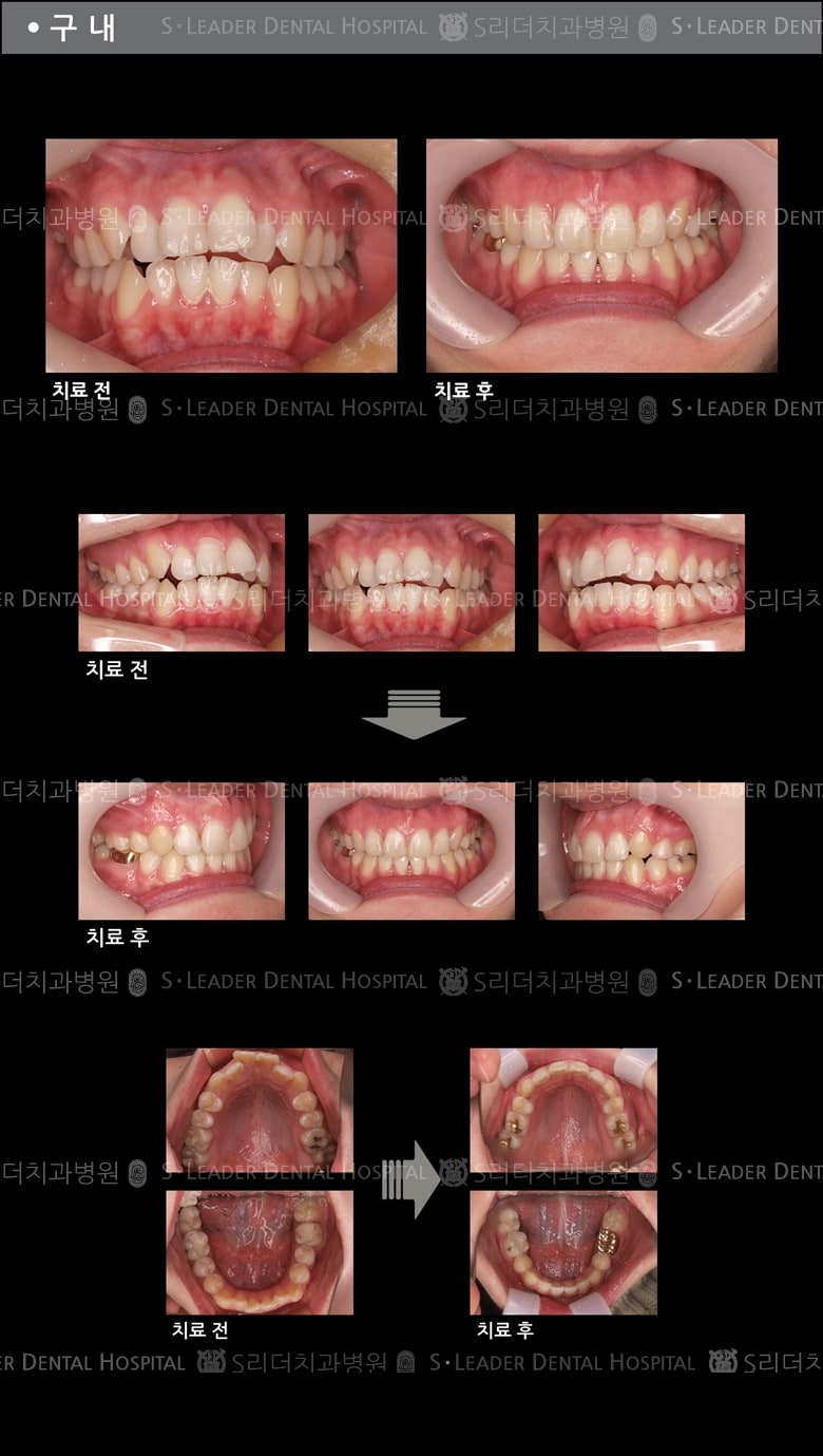 돌출입 교정 케이스 (class 2) — 추가 사진 (치아교정)