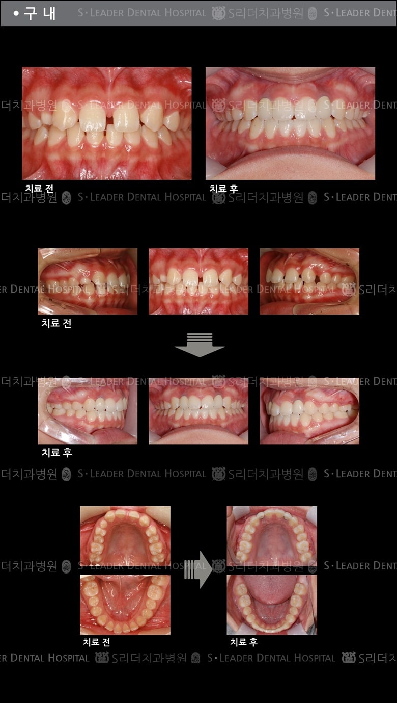 선천적 치아결손의 케이스 (특수한 케이스) — 추가 사진 (치아교정)