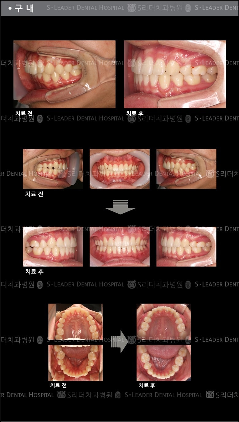 돌출입 교정 케이스 (class 2) — 추가 사진 (치아교정)