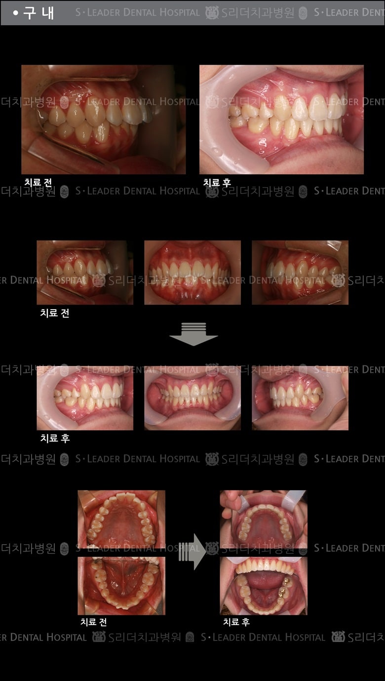 돌출입 교정 케이스 (class 2) — 추가 사진 (치아교정)