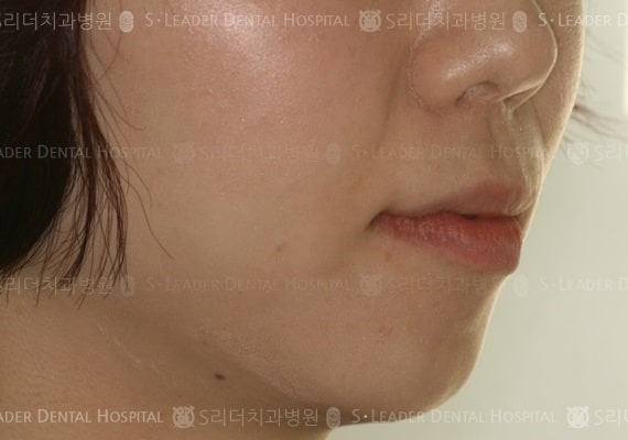 돌출입 교정 케이스 (class 2) (증례 354)