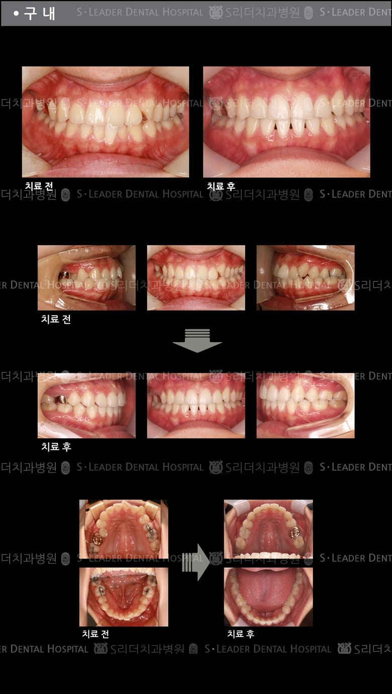삐뚤삐뚤 치아교정 케이스 (class3) — 추가 사진 (치아교정)
