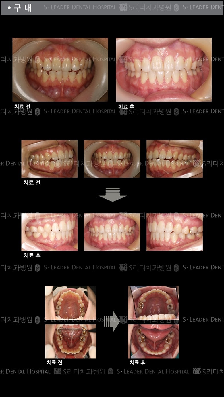 돌출입 교정 케이스 (class 2) — 추가 사진 (치아교정)