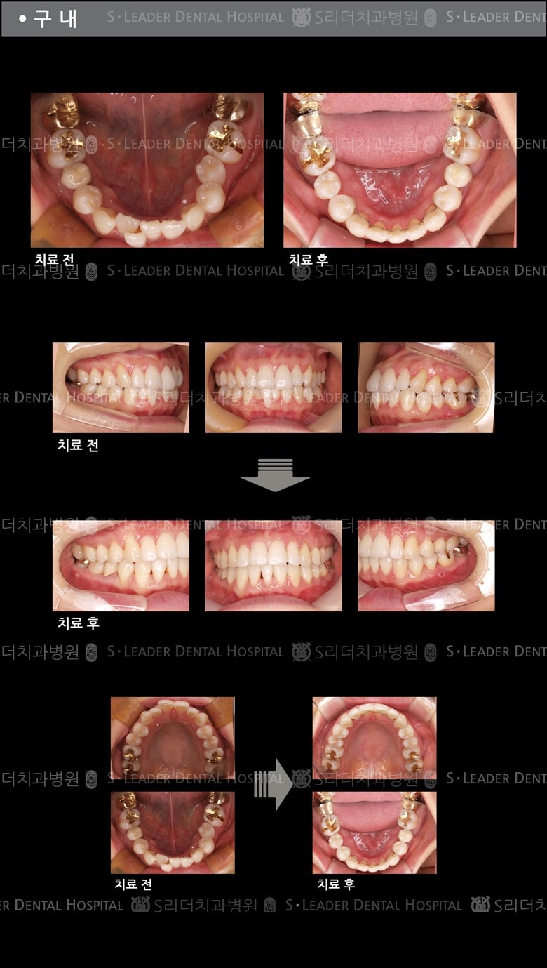 삐뚤삐뚤 치아교정 케이스 (class3) — 추가 사진 (치아교정)