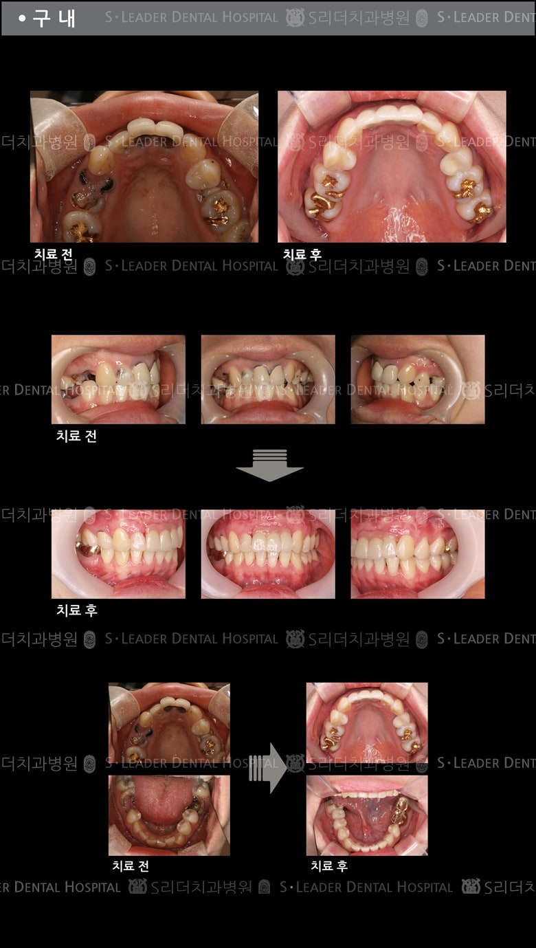 다수치아의 상실의 경우 (특수한 케이스) — 추가 사진 (치아교정)