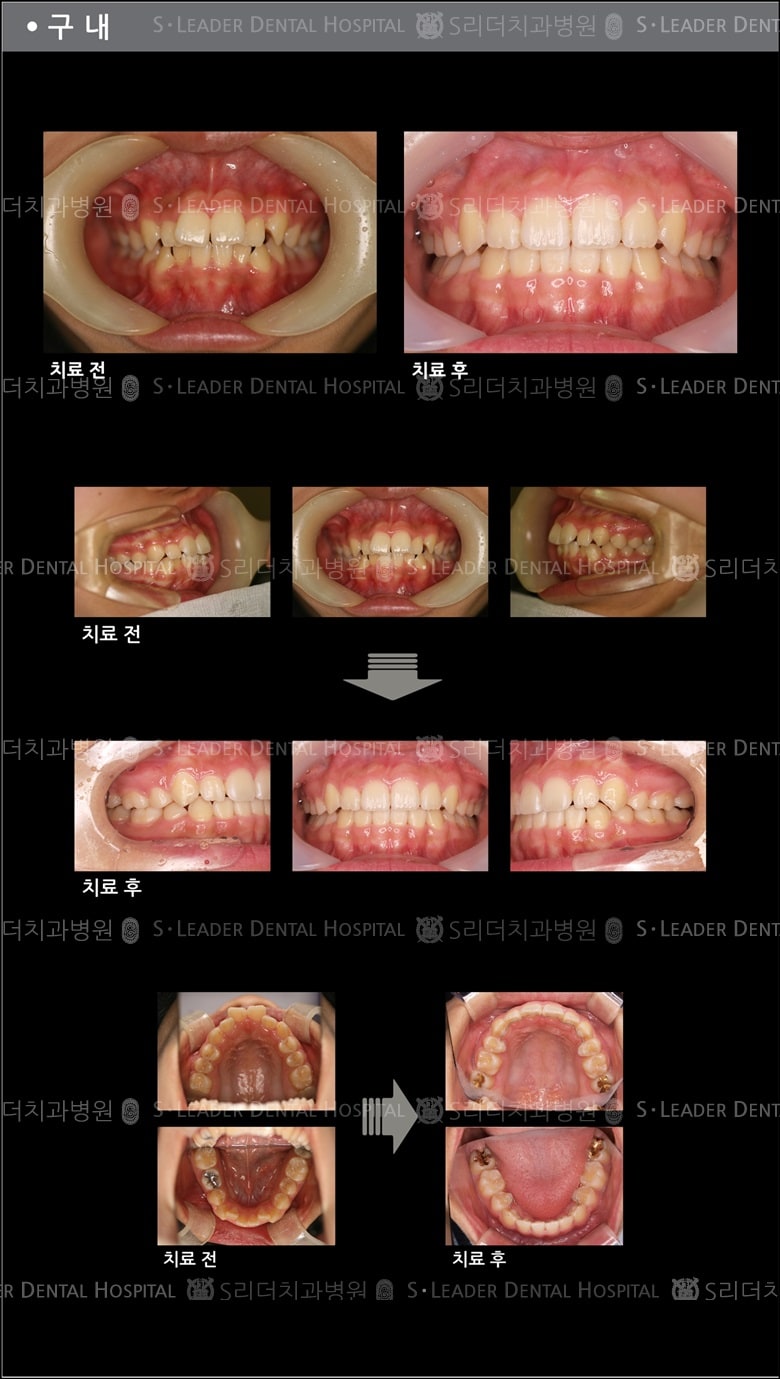 돌출입 교정 케이스 (class 2) — 추가 사진 (치아교정)