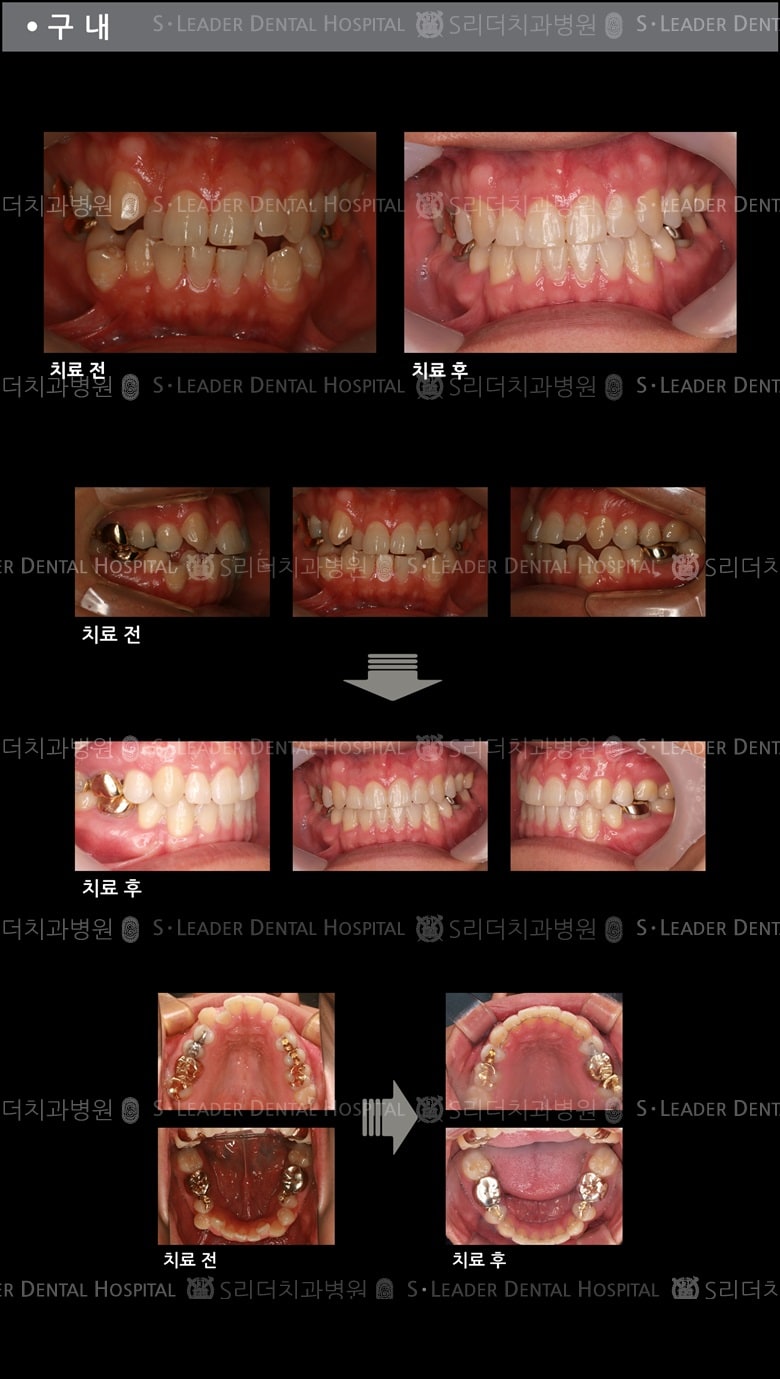 삐뚤삐뚤 치아교정 케이스 (class3) — 추가 사진 (치아교정)