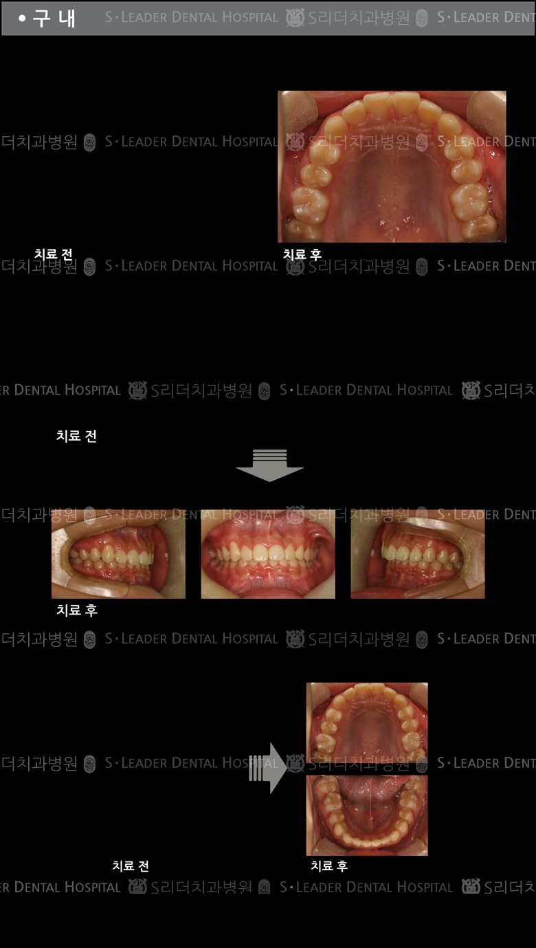 돌출입 교정 케이스 (class 2) — 추가 사진 (치아교정)