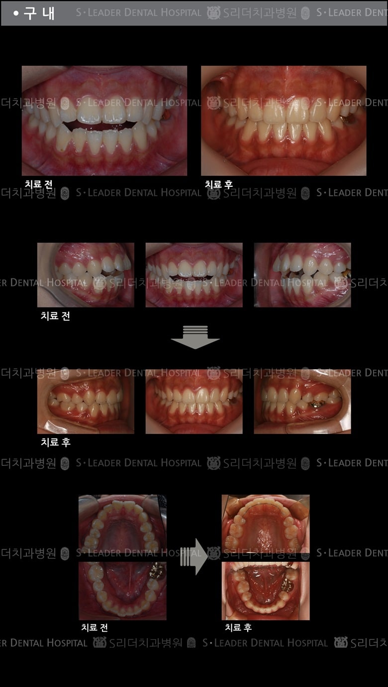 벌어진 입 케이스(Class 2) — 추가 사진 (치아교정)