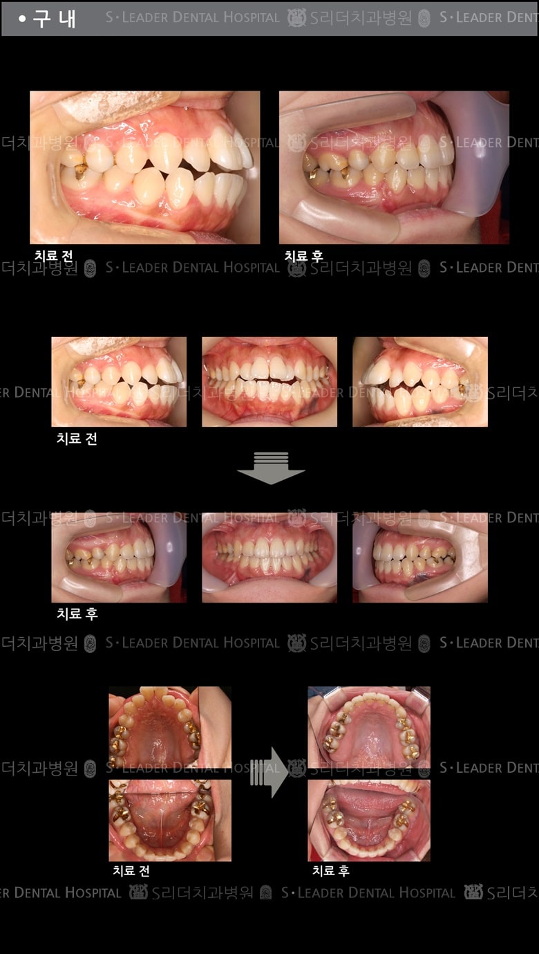 돌출입 교정 케이스 (class 2) — 추가 사진 (치아교정)