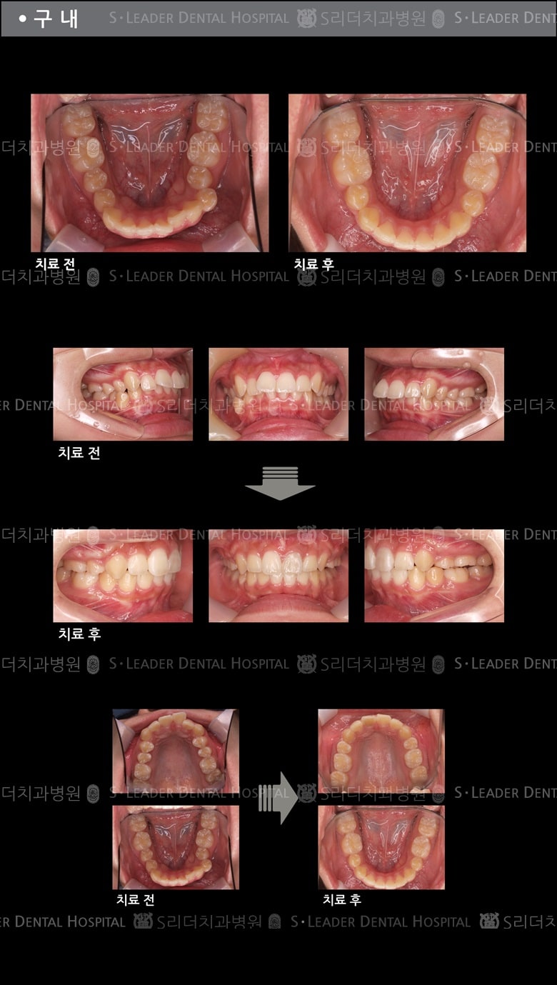돌출입 교정 케이스 (class 2) — 추가 사진 (치아교정)
