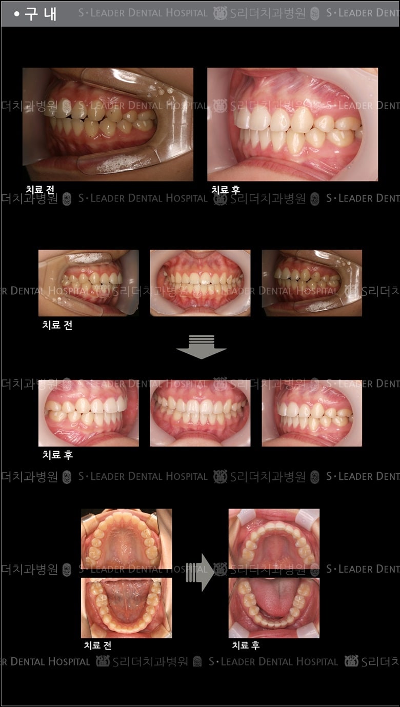 돌출입 교정 케이스 (class 2) — 추가 사진 (치아교정)