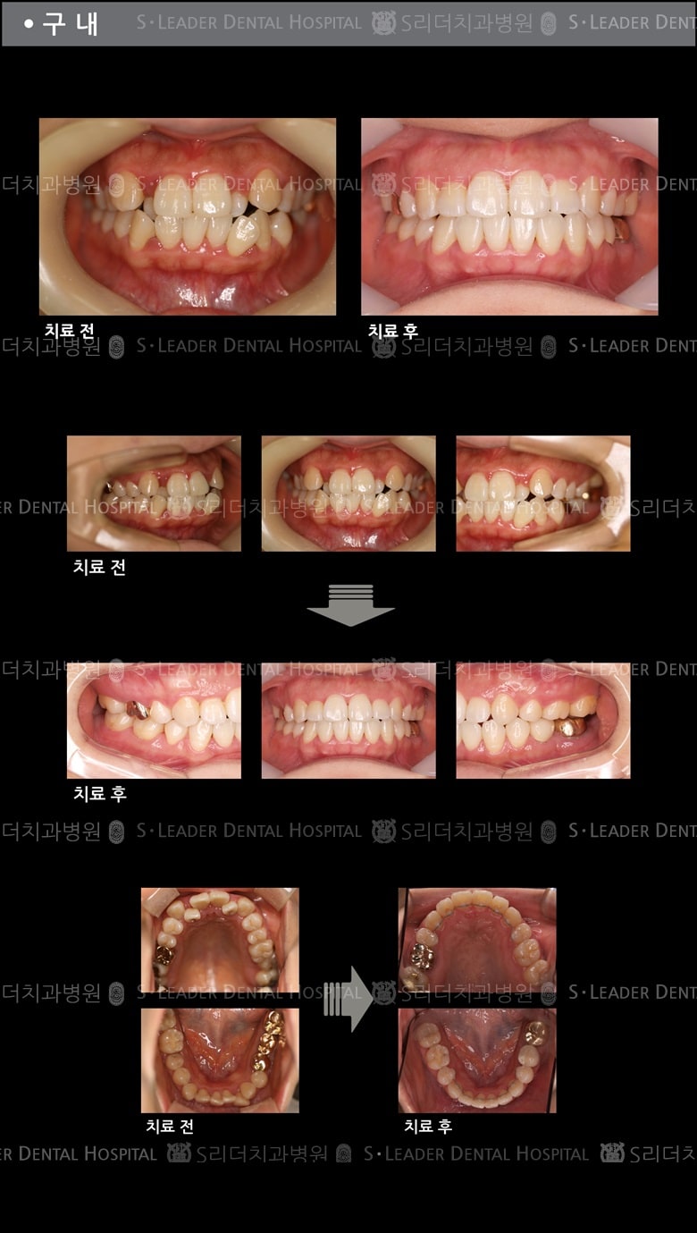 벌어진 입 케이스(Class 2) — 추가 사진 (치아교정)