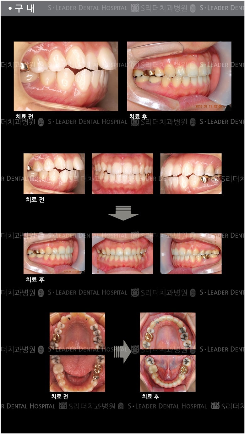 돌출입 교정 케이스 (class2) — 추가 사진 (치아교정)