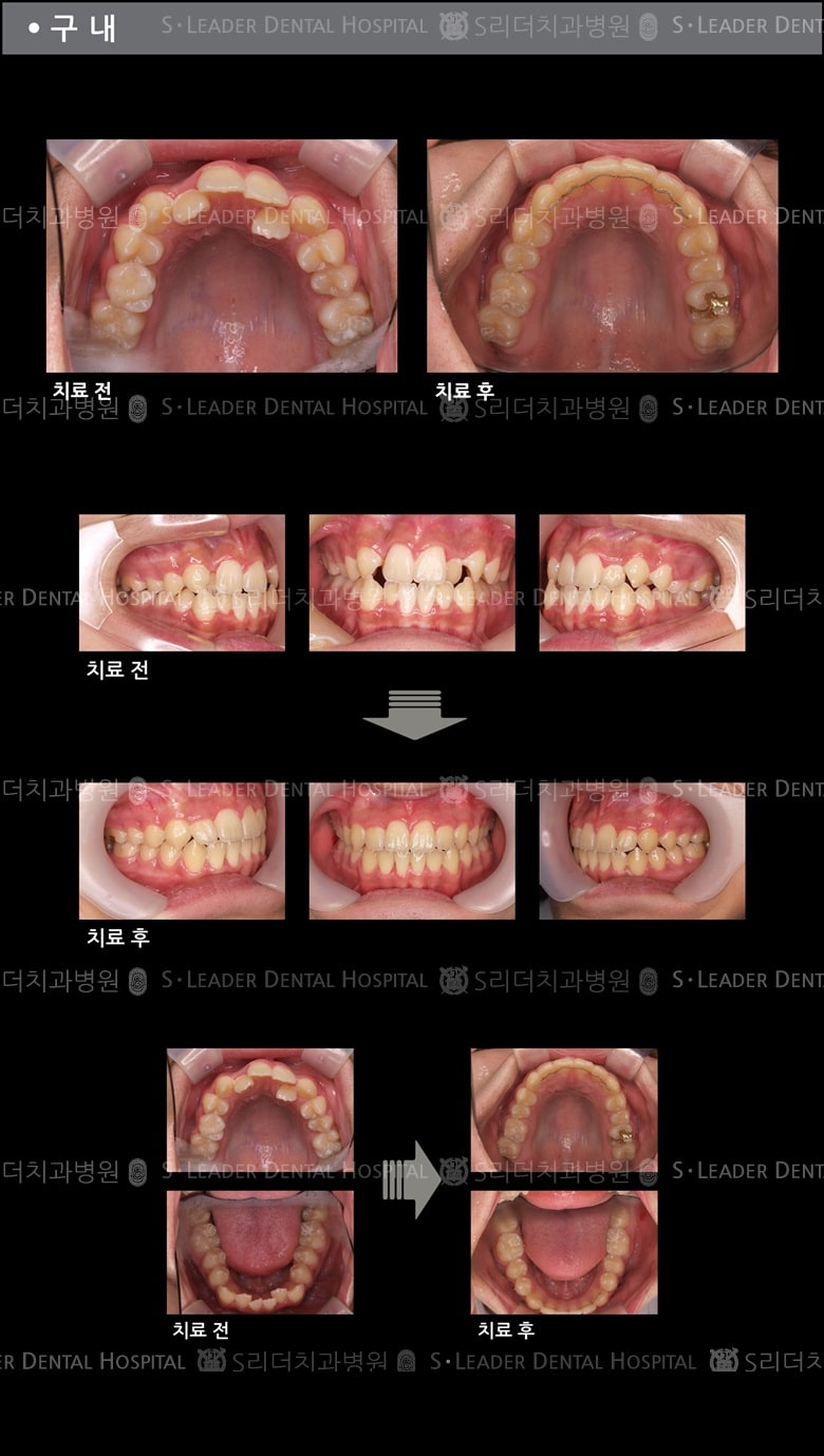 삐뚤삐뚤 치아교정 케이스 (class3) — 추가 사진 (치아교정)