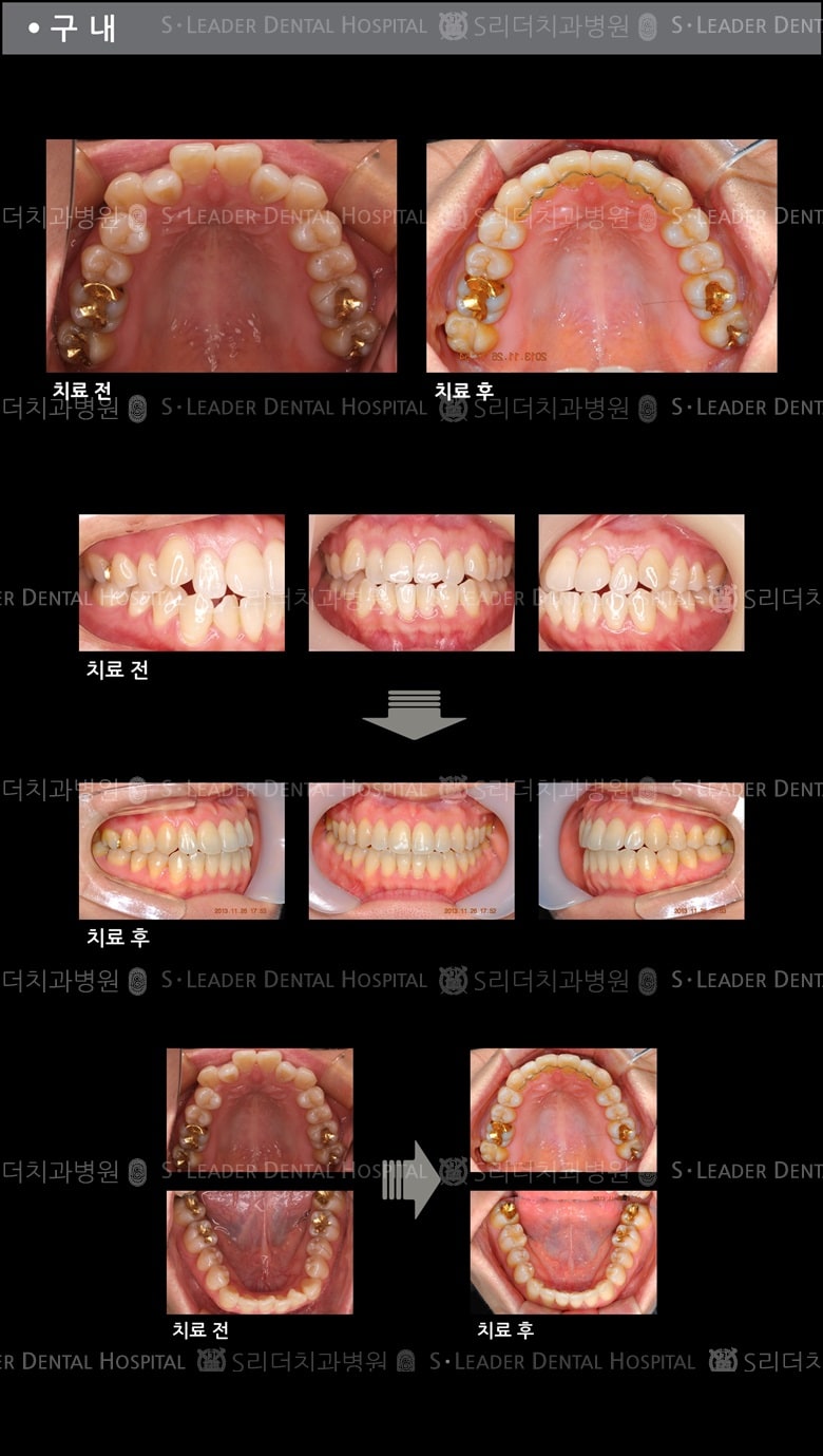 삐뚤삐뚤 치아교정 케이스 (class3) — 추가 사진 (치아교정)