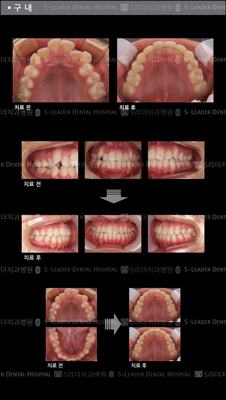 돌출입 교정 케이스 (class 3) — 추가 사진 (치아교정)