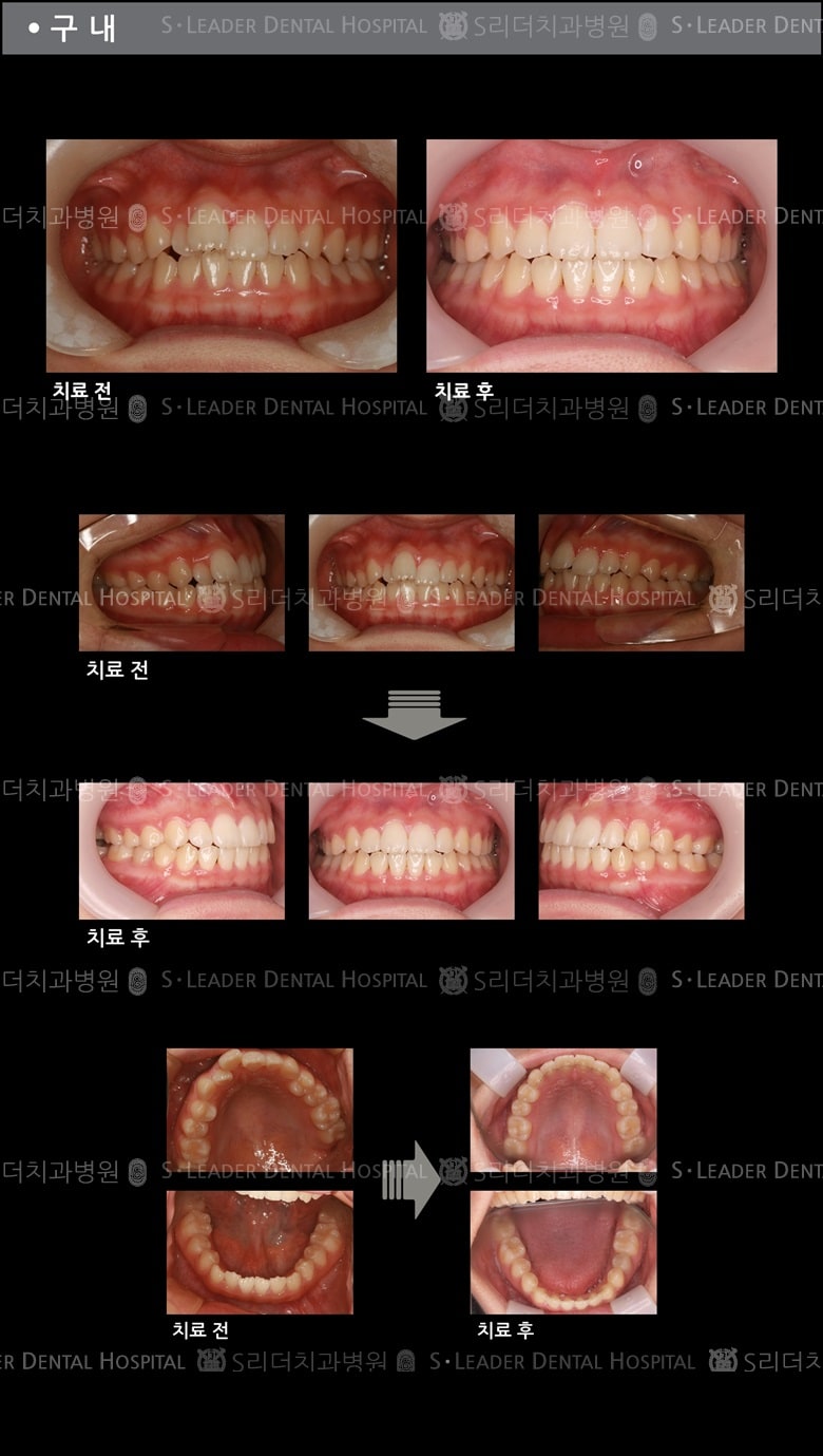 삐뚤삐뚤 치아교정 케이스 (class3) — 추가 사진 (치아교정)