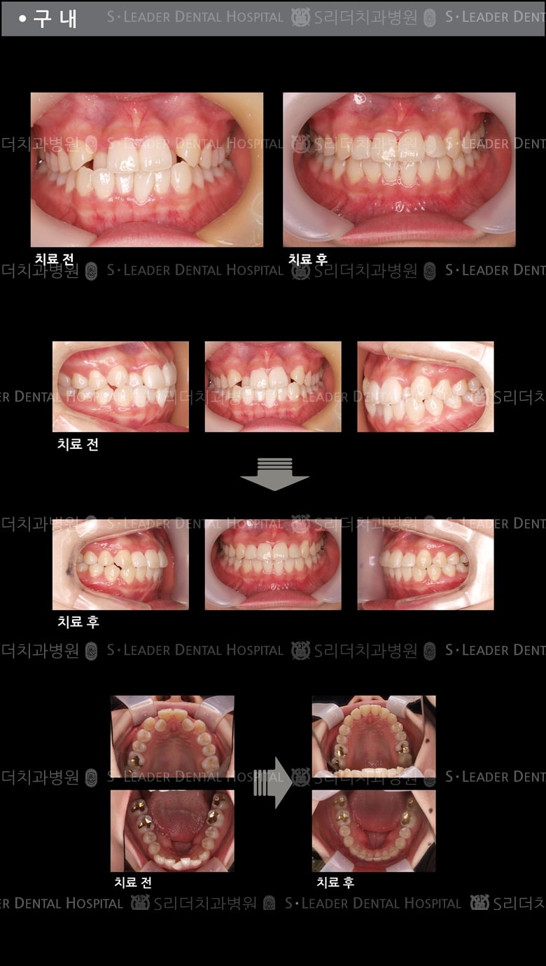 삐뚤삐뚤 치아교정 케이스 (class3) — 추가 사진 (치아교정)