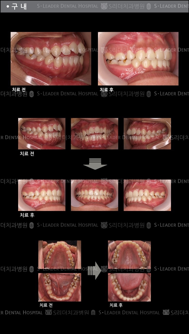 벌어진 입 케이스(Class 2) — 추가 사진 (치아교정)