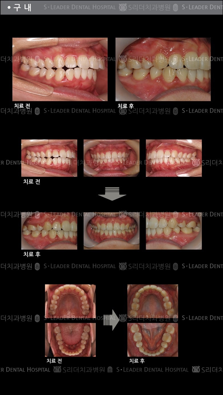 돌출입 교정 케이스 (class 2) — 추가 사진 (치아교정)