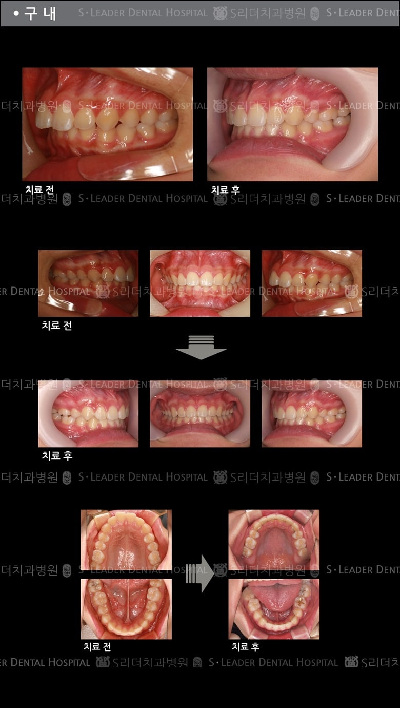 돌출입 교정 케이스 (class 2) — 추가 사진 (치아교정)