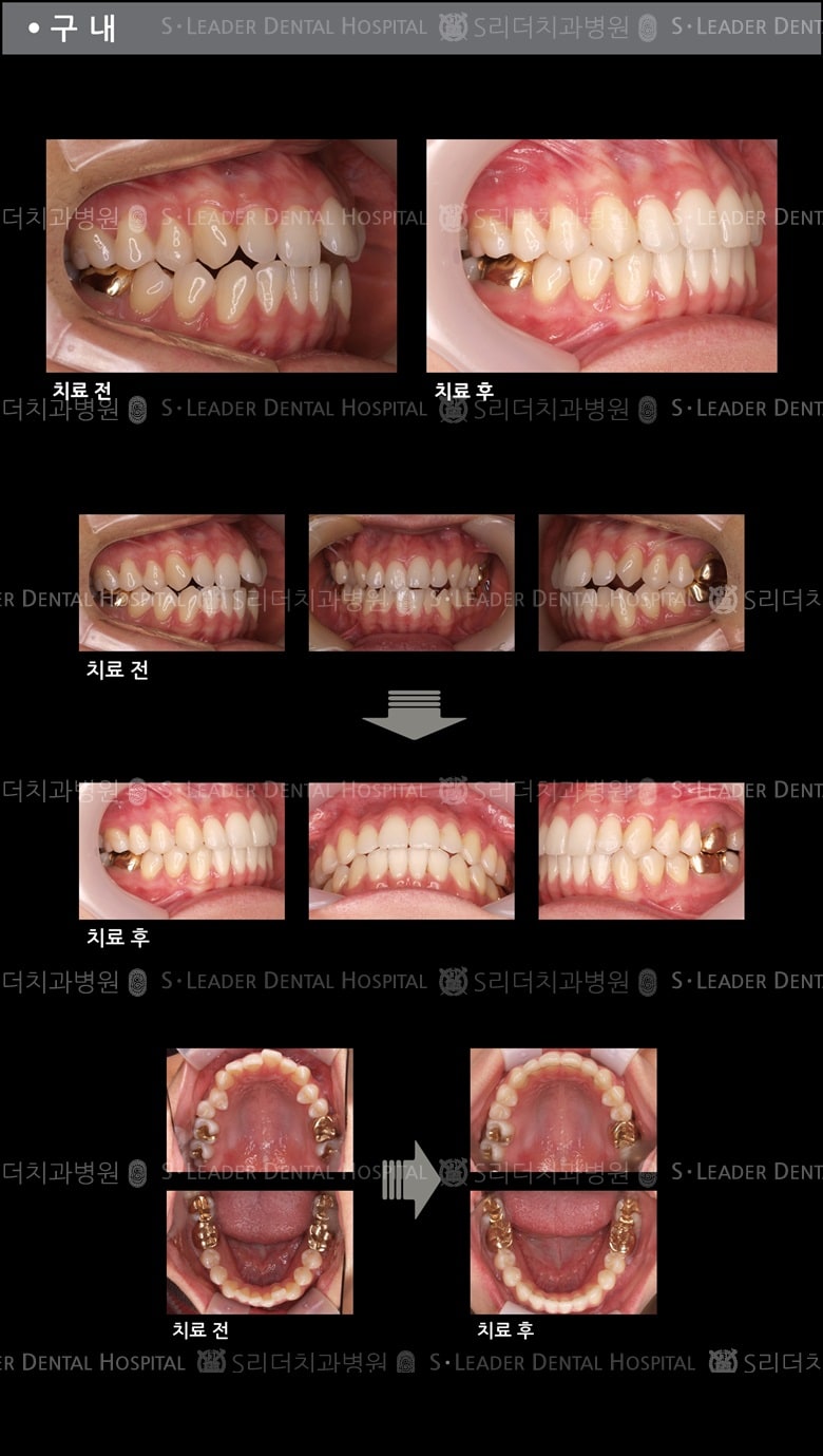 벌어진 입 케이스(Class 2) — 추가 사진 (치아교정)