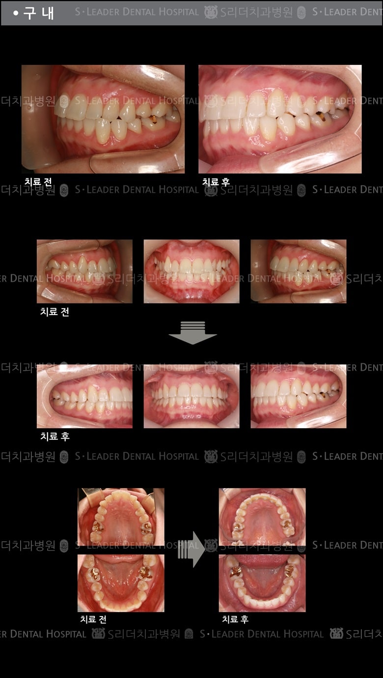 삐뚤삐뚤 치아교정 케이스 (class3) — 추가 사진 (치아교정)