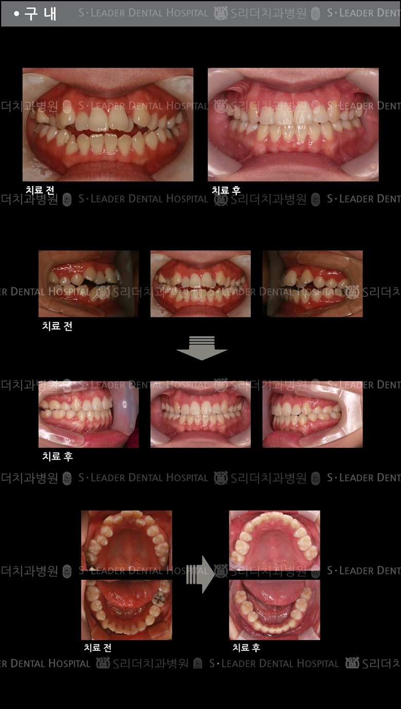벌어진 입 케이스(Class 2) — 추가 사진 (치아교정)