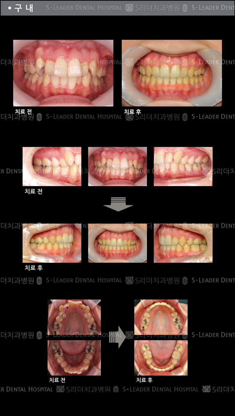 돌출입 교정 케이스 (class2) — 추가 사진 (치아교정)
