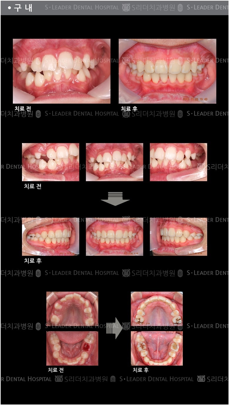 돌출입 교정 케이스 (class2) — 추가 사진 (치아교정)