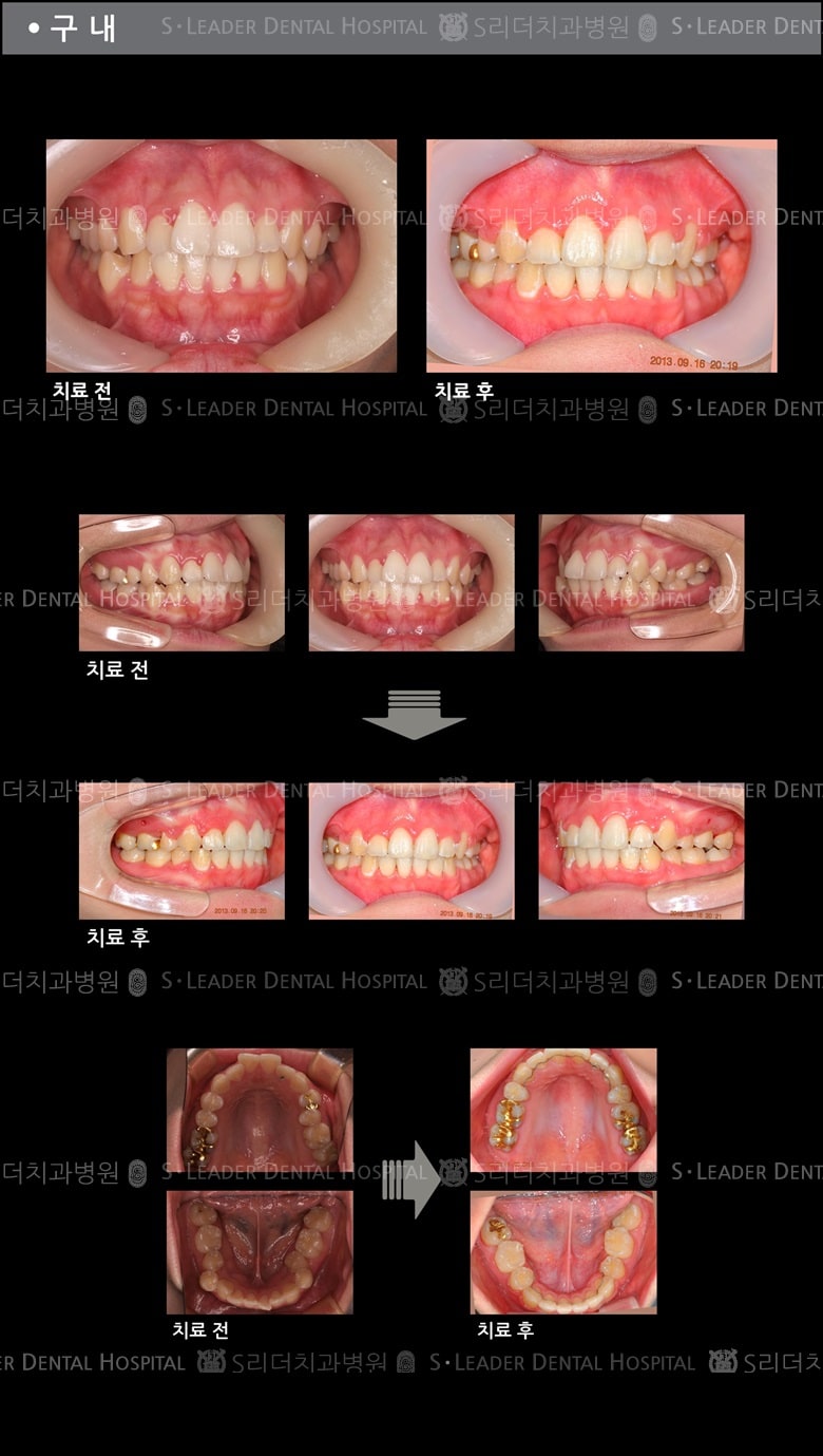 돌출입 교정 케이스 (class2) — 추가 사진 (치아교정)