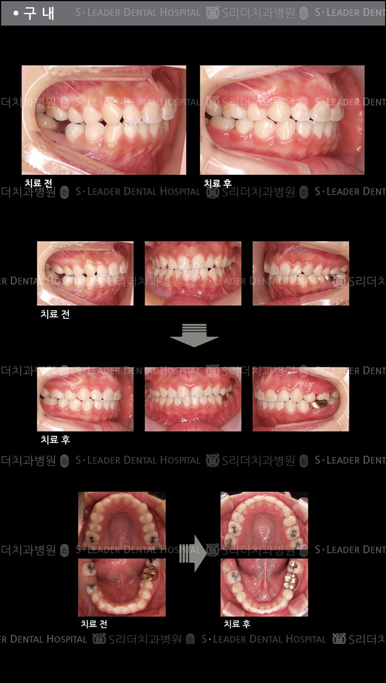 돌출입 교정 케이스 (class2) — 추가 사진 (치아교정)