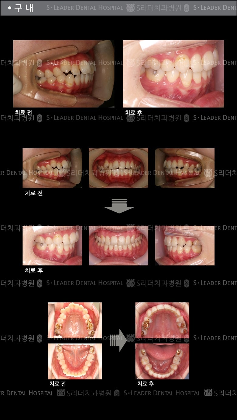 돌출입 교정 케이스 (class2) — 추가 사진 (치아교정)