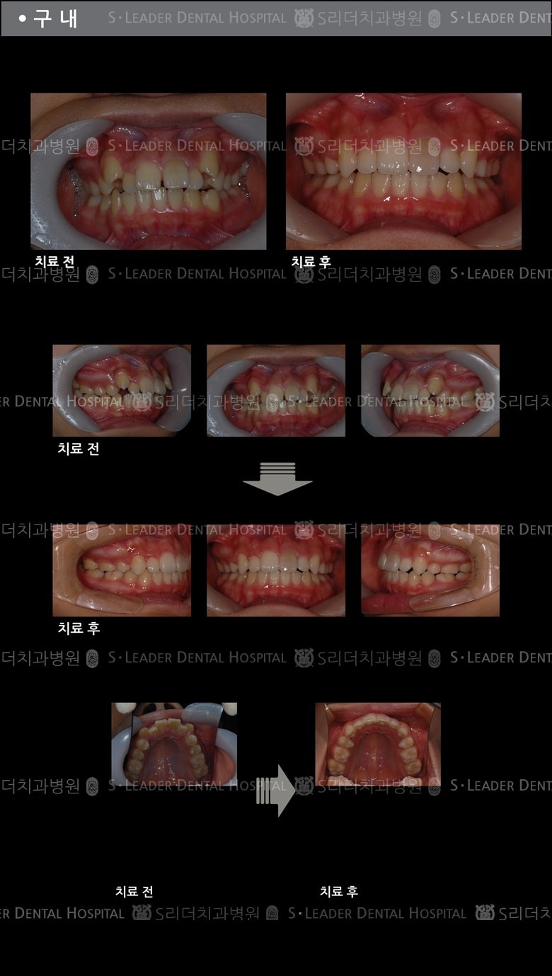 돌출입 교정 케이스 (class2) — 추가 사진 (치아교정)