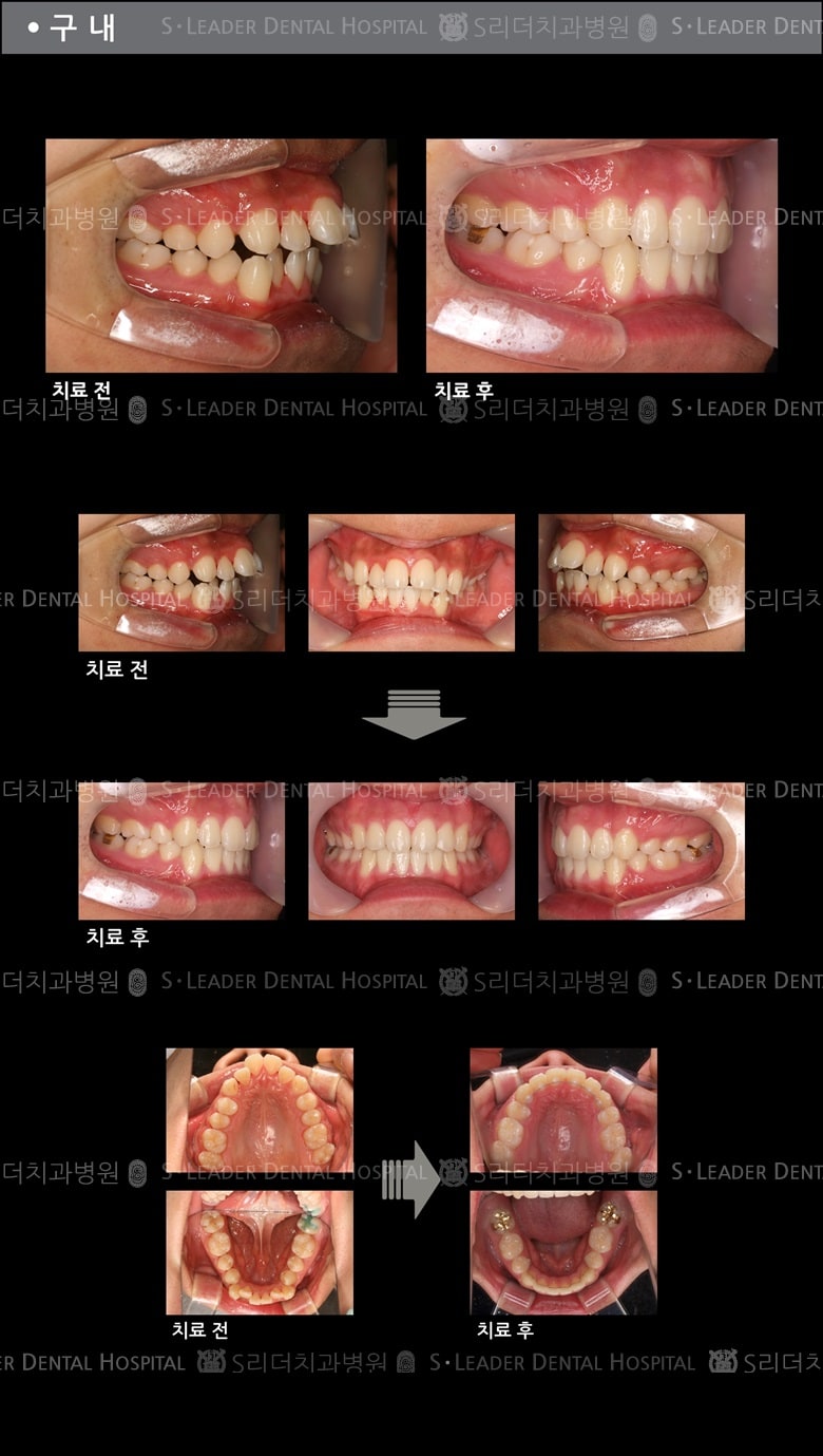 돌출입 교정 케이스 (class2) — 추가 사진 (치아교정)