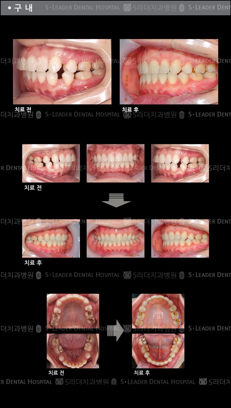 돌출입 교정 케이스 (class2) — 추가 사진 (치아교정)