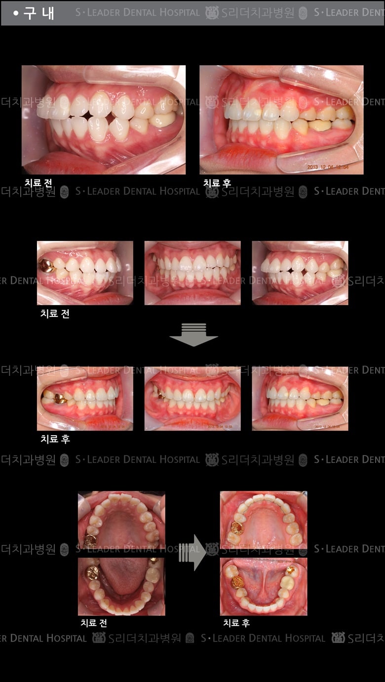 돌출입 교정 케이스 (class2) — 추가 사진 (치아교정)