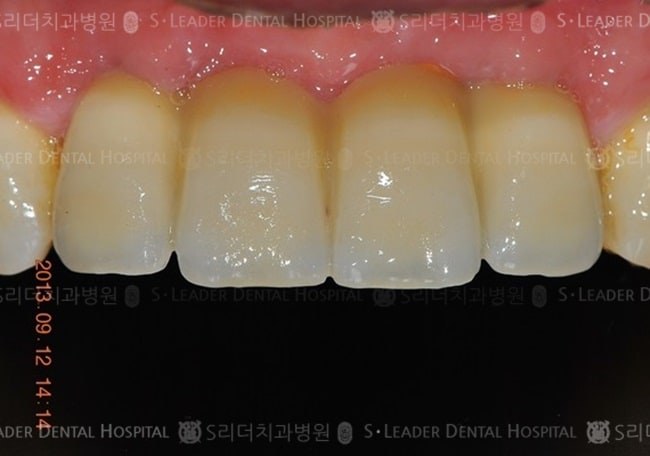 앞니 4개, 만 53세 남성환자 (증례 455)