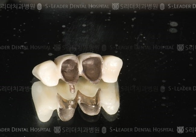 만 28세 여성환자, 아래니4개치료 — 추가 사진 (심미보철)