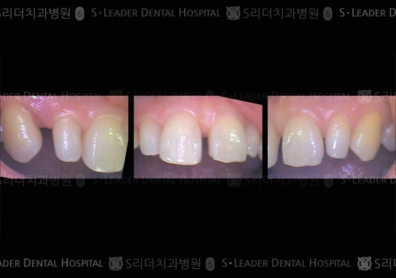앞니2개 심미보철+부분교정, 만52세 여성환자 (증례 38)