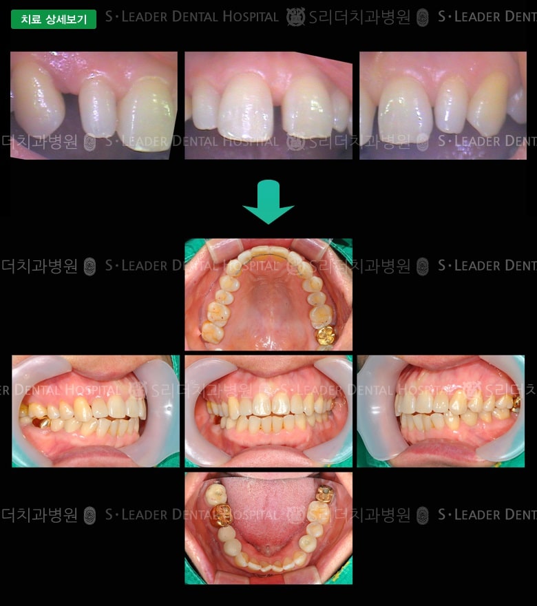 앞니2개 심미보철+부분교정, 만52세 여성환자 — 추가 사진 (대표 사례)