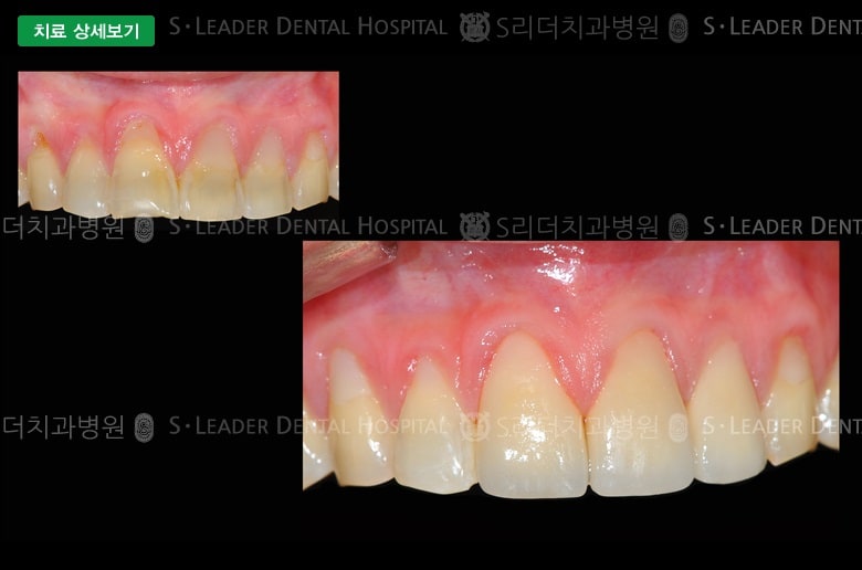 앞니 4개 (심미보철), 만52세 여성환자 — 추가 사진 (대표 사례)