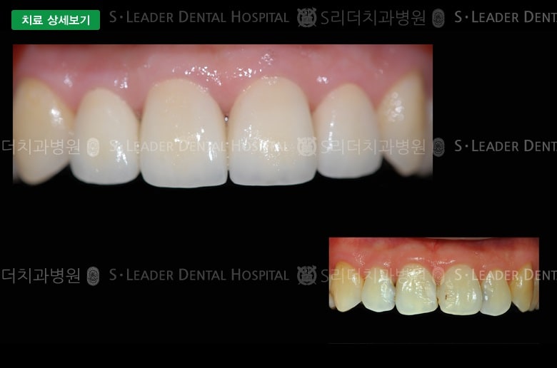 앞니 4개 치료, 만32세 남성환자 — 추가 사진 (대표 사례)